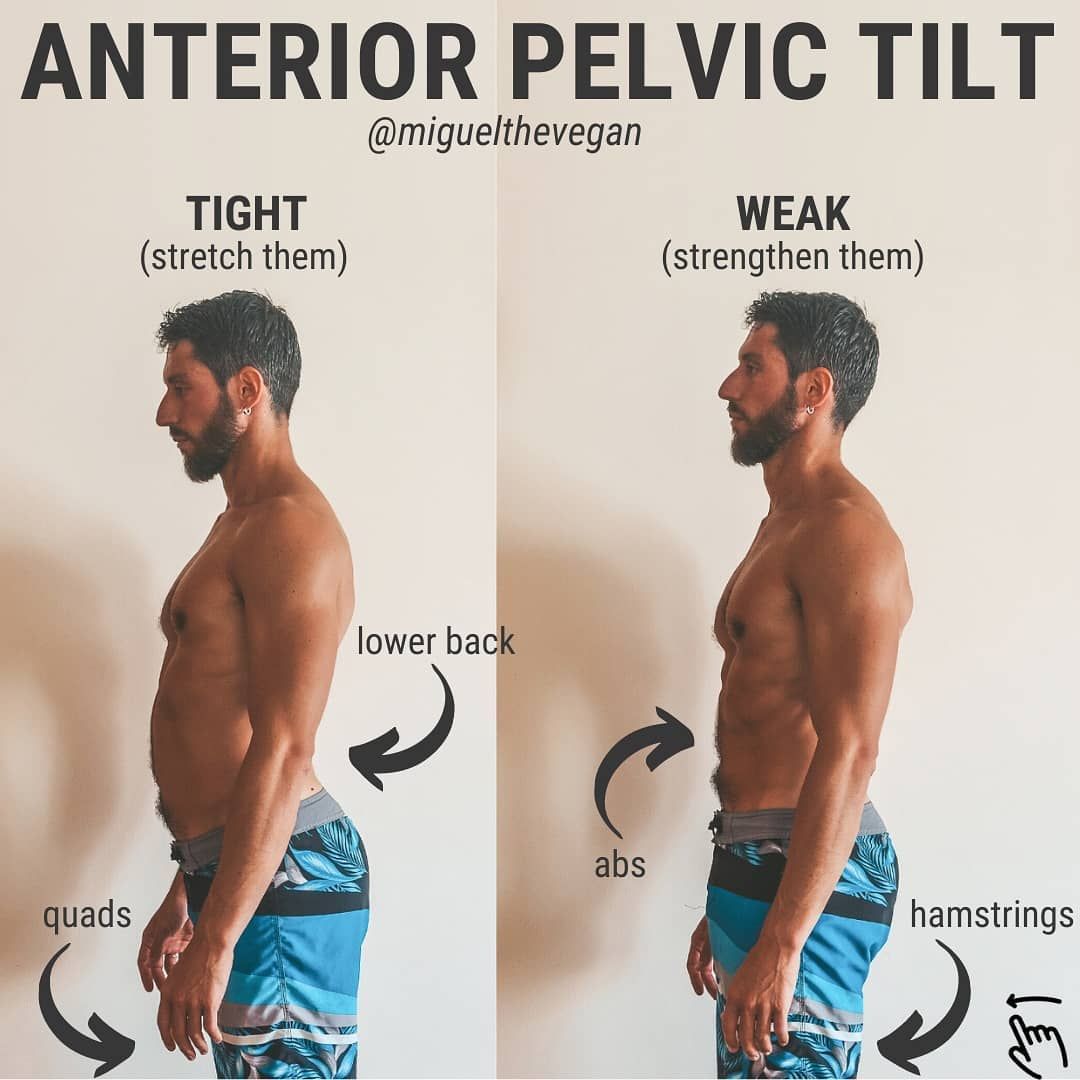 Before and after images showing anterior pelvic tilt. Helps compare alignment and improve daily movement habits.